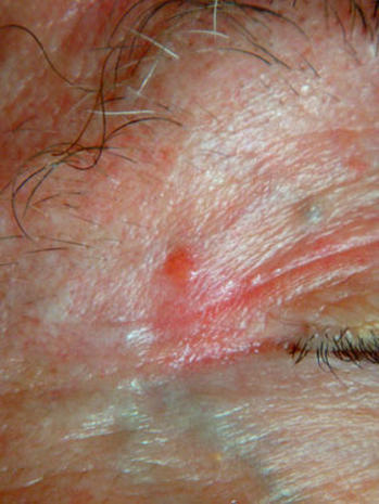 york skin treatment cancer?  skin  Is Is  skin  it cancer? Pictures CBS News it