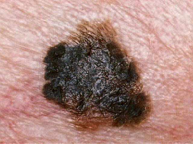 is it skin cancer cbs news is it skin cancer cbs news