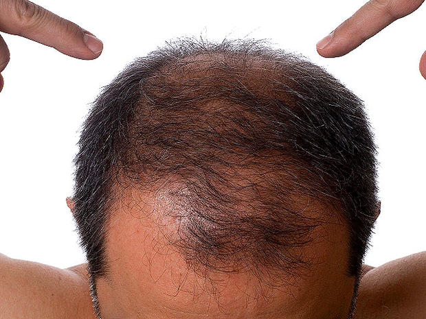Hair Loss Radiation Sickness 8 Terrifying Symptoms Pictures