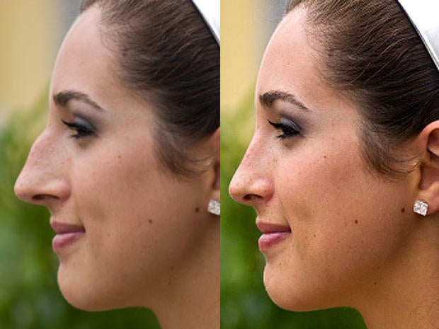 2 Nose Reshaping Rhinoplasty 10 Most Popular Plastic Surgery Procedures Cbs News