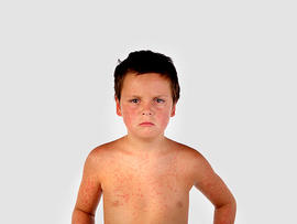 measles, boy, vaccine, stock, 4x3