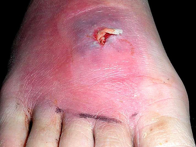 Deadly Skin Infection 12 Graphic Photos That Could Save Your Life