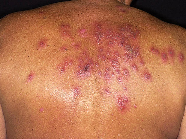 Myth Shingles Isnt Contagious Is It Shingles 7 Myths About Painful