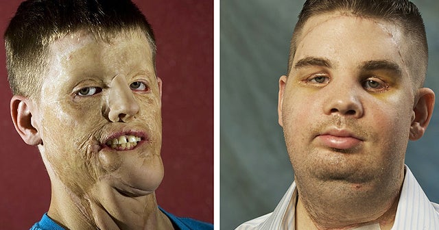 Mitch Hunter S Amazing New Face Transplant Patient Leaves Hospital Photo 7 Cbs News