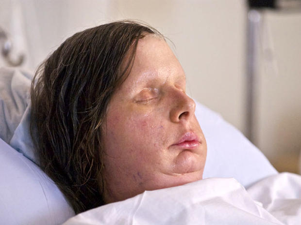 charla nash, chimp attack, face transplant 