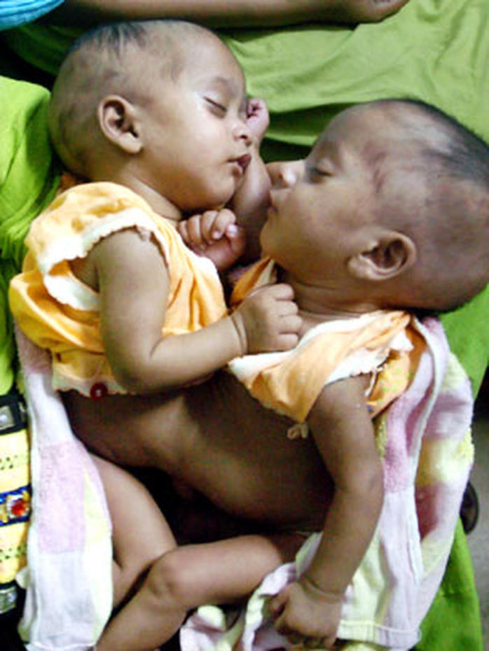 Conjoined Twins WARNING GRAPHIC IMAGES CBS News