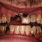 Meth Mouth Inside Look At Icky Problem Graphic Images Photo