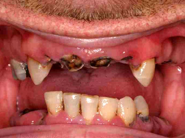 Meth mouth Inside look at icky problem (15 GRAPHIC IMAGES
