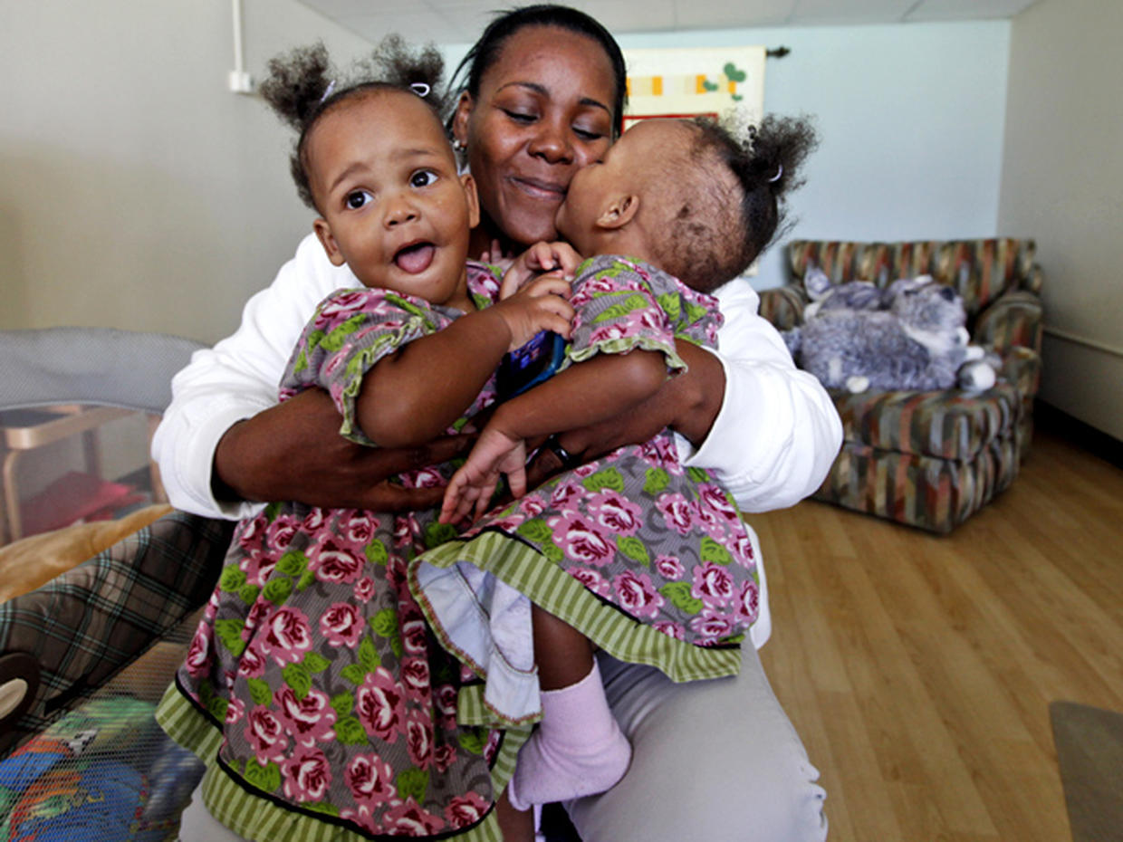 Conjoined twins Maria & Teresa Tapia Before and after Photo 1 CBS News