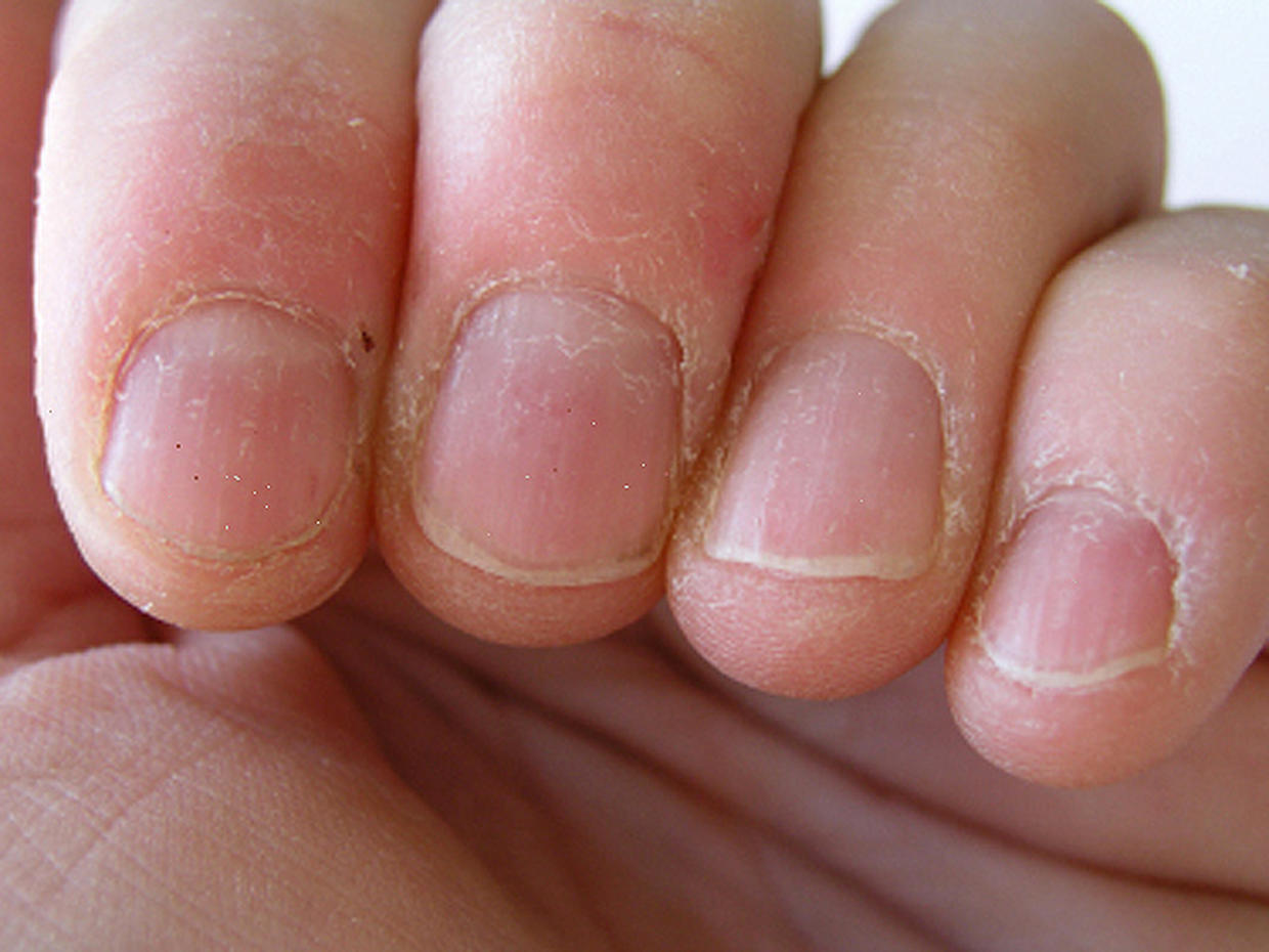 Pitted nails What your looks say about your health CBS News