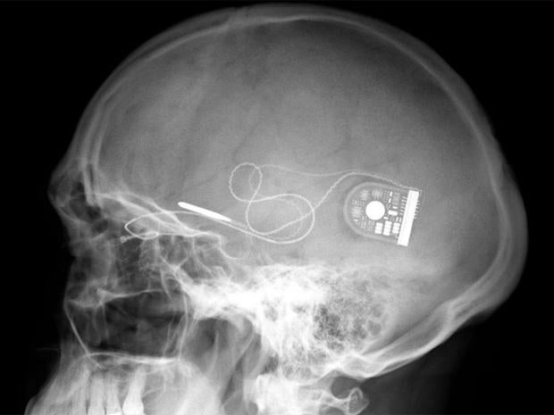 eye implant