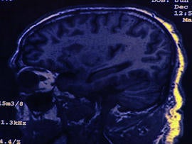 Alzheimer's prevention experiment, whooping cough outbreak