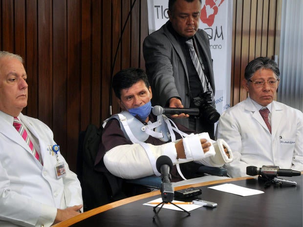 double arm transplant, mexico