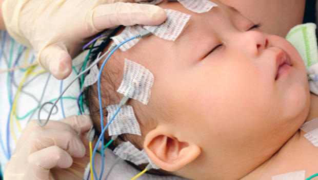 Can Eeg Detect Brain Damage