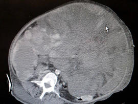 51-pound tumor