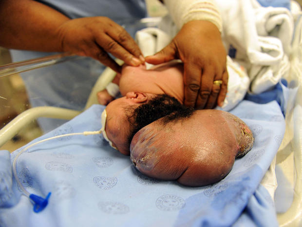Baby born with brain outside its head dies in South Africa ...