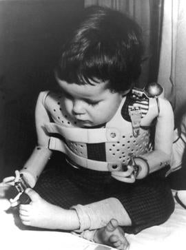 A 3-year-old girl, born without arms to a German mother who took the drug thalidomide, uses power-driven artificial arms in 1965.