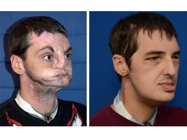 Amazing Face Transplants Graphic Images Cbs News