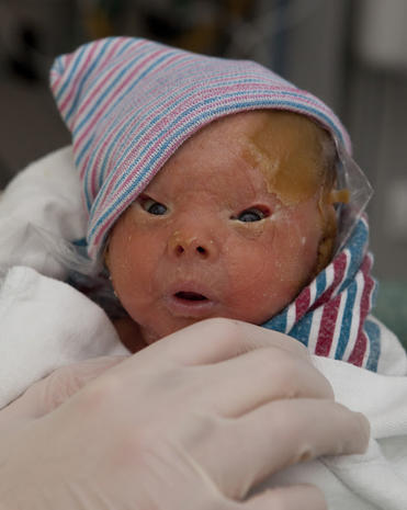 Meet Brenna, a baby with Harlequin Ichthyosis - Photo 24 ...