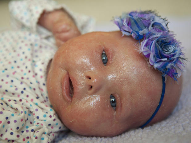 Meet Brenna, a baby with Harlequin Ichthyosis - Photo 16 ...