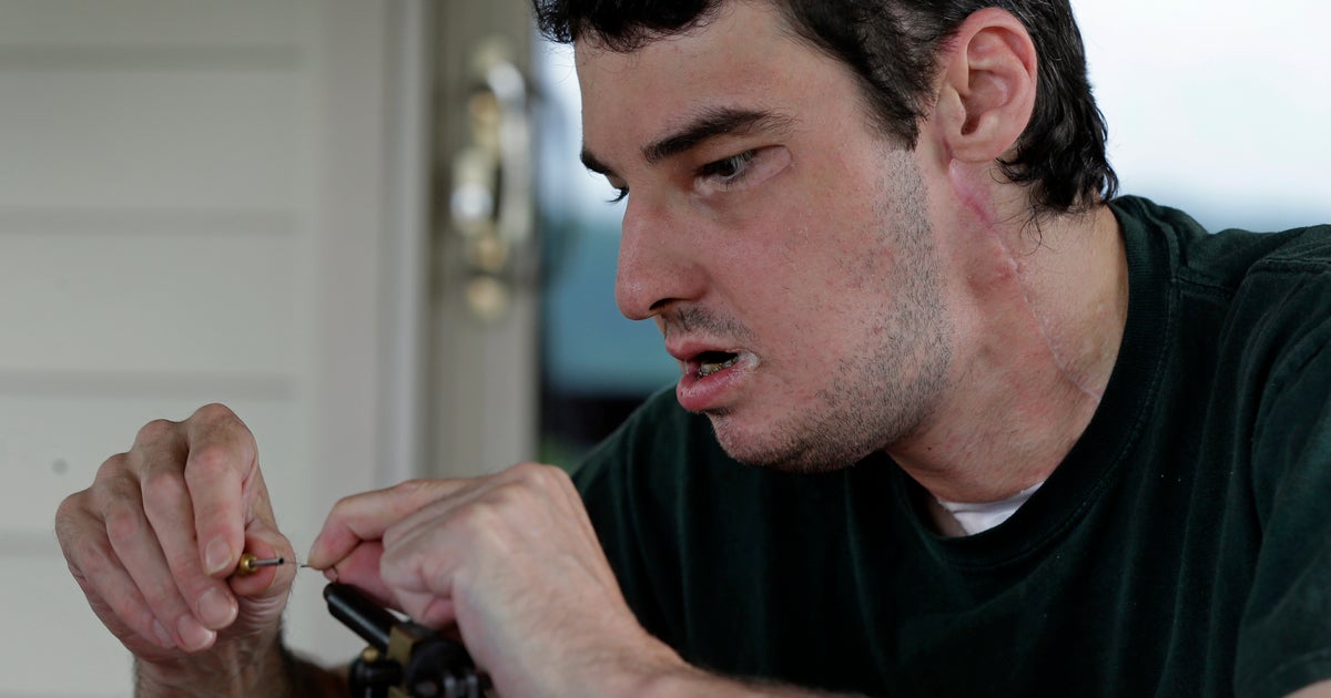 Face Transplant Patients Return To Normal Life P O 17 Pictures Cbs News Face Transplant Patients Return To Normal Life P O 17 Pictures Cbs News
