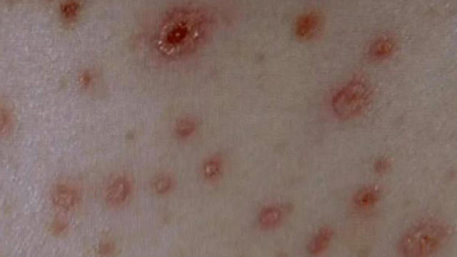 measles1.jpg 
