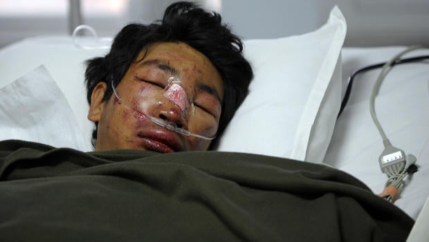 Nepalese mountaineer Dawa Tashi Sherpa, survivor of an avalanche on Mount Everest, lies in the Intensive Care Unit at Grandi International Hospital in Katmandu, Nepal, April 18, 2014.