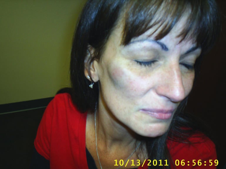 michele-williams-bruise.jpg