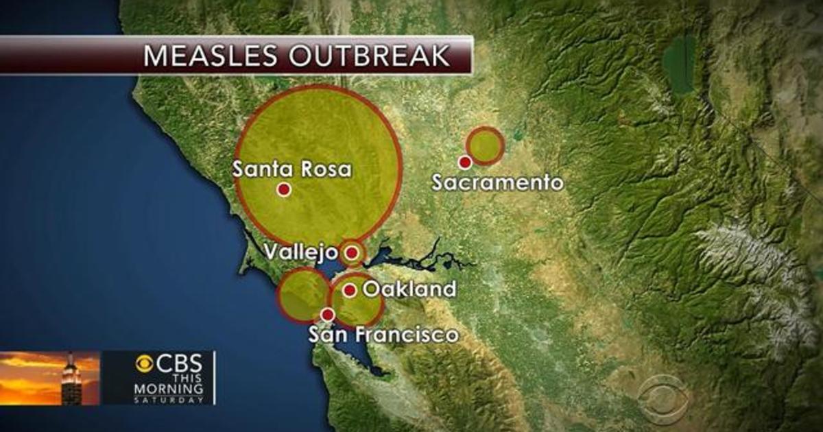 Measles Cases Measles outbreak More than two dozen children quarantined 