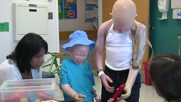New limbs, new hope for Africa's hunted albino children 