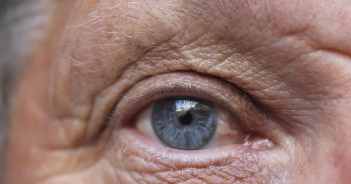 Doctors seek new hope for patients with eye stroke
