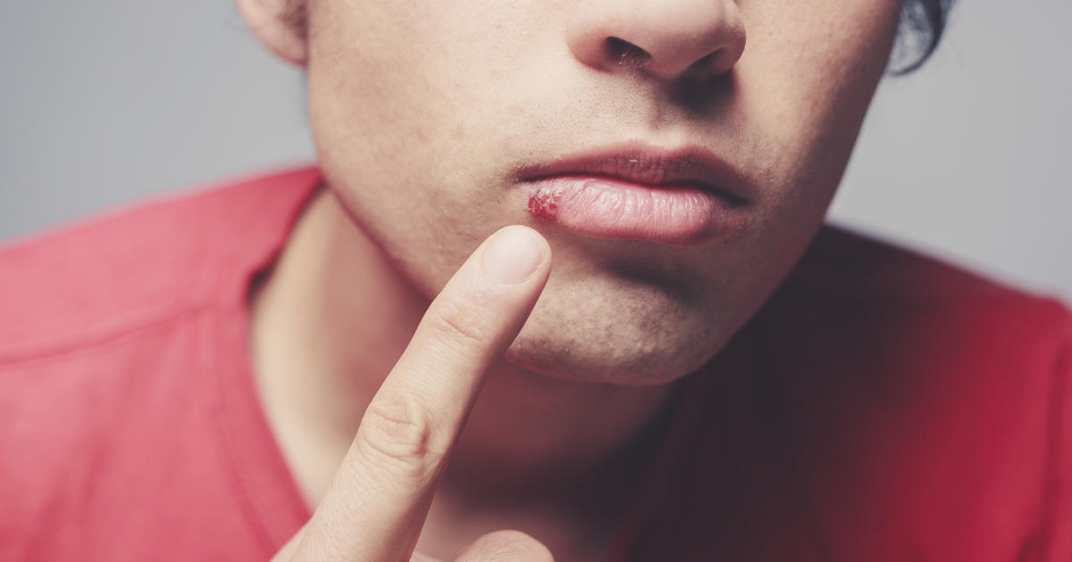 everything you need to know about dating someone with herpes