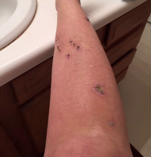 Woman Shares Graphic Images To Spread Skin Cancer Warning Cbs News