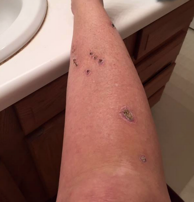 Woman shares graphic images to spread skin cancer warning CBS News