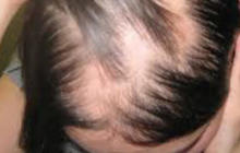Drug shows promise for hair loss condition