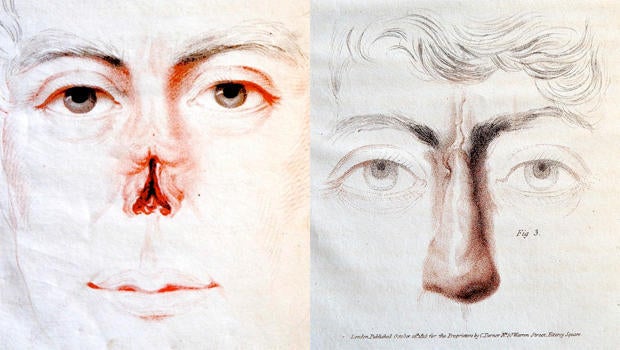 joseph-constantine-carpue-nasal-reconstruction-surgery-620.jpg