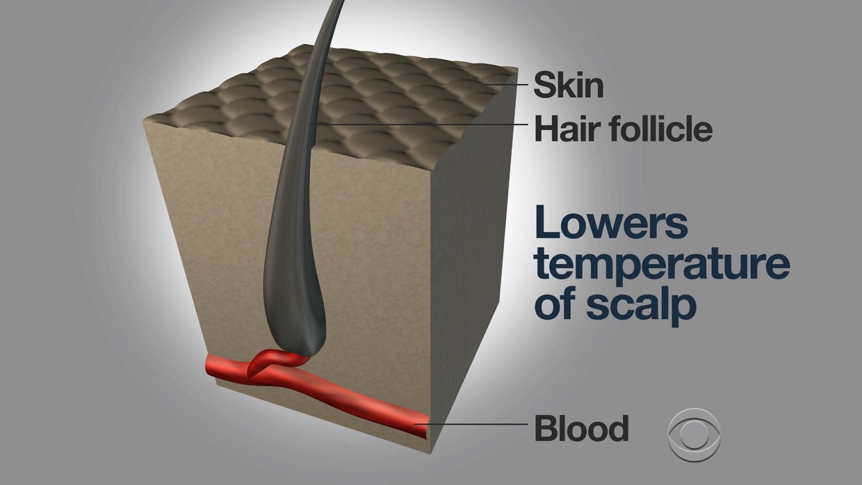 Studies reveal effectiveness of cooling caps in fighting chemoinduced