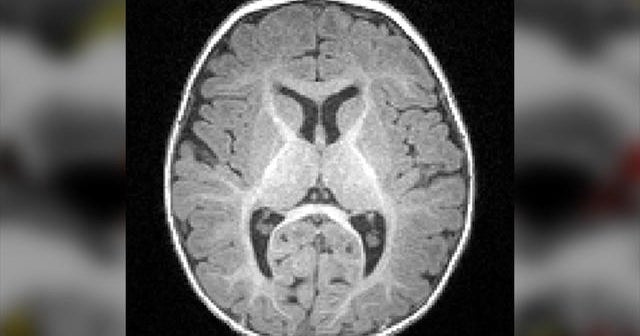Uncovering Early Signs Of Autism >> Brain Study Spots Early Signs Of Autism Cbs News Uncovering Early Signs Of Autism >> Brain Study Spots Early Signs Of Autism Cbs News