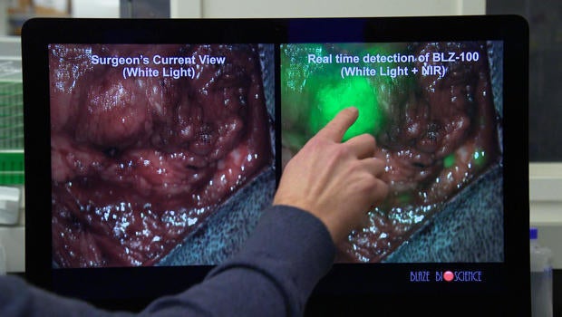 tumor-paint-on-screen-620.jpg