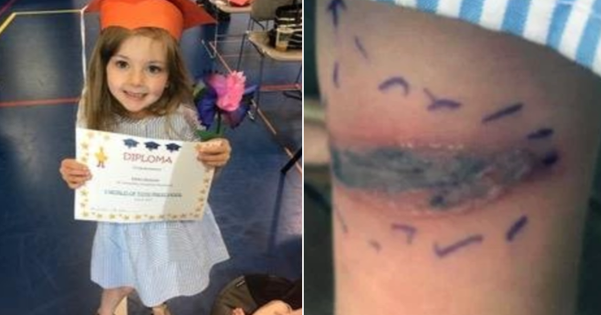 Black Widow Spider Bite Sends 5 Year Old Girl To Emergency Room Cbs News