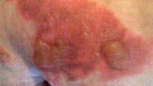 A photo provided to CBS Denver station KCNC-TV shows burns that Deanna Solas-Solando claims were caused by a Starbucks drink.