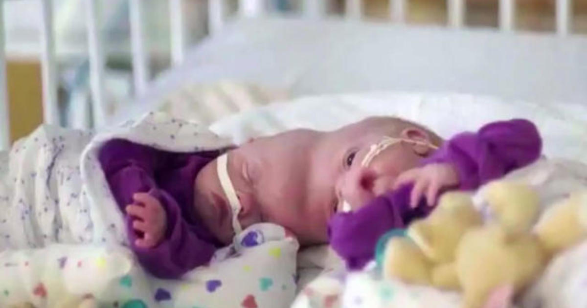 Formerly Conjoined Twins Undergo Risky 11 Hour Surgery To Be Separated Cbs News