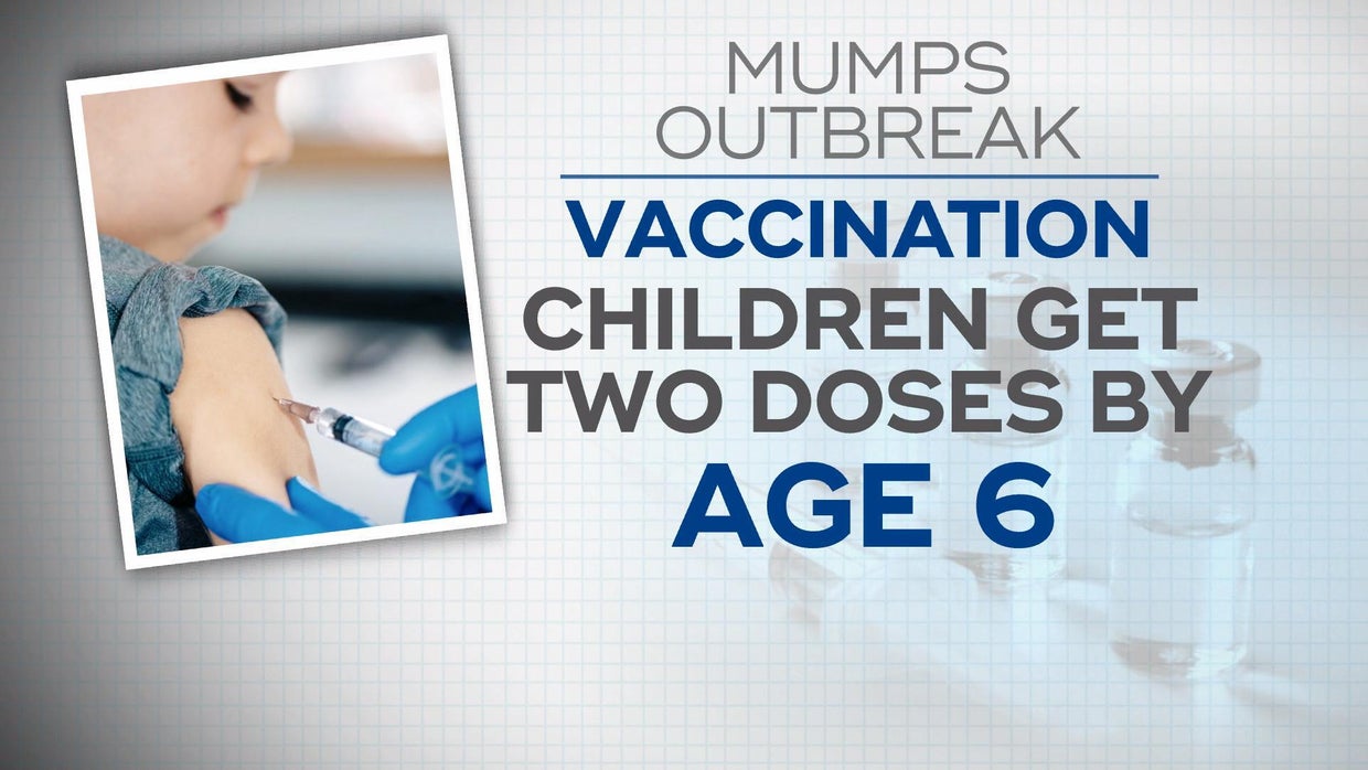 Highly contagious mumps virus strikes among vaccinated young adults