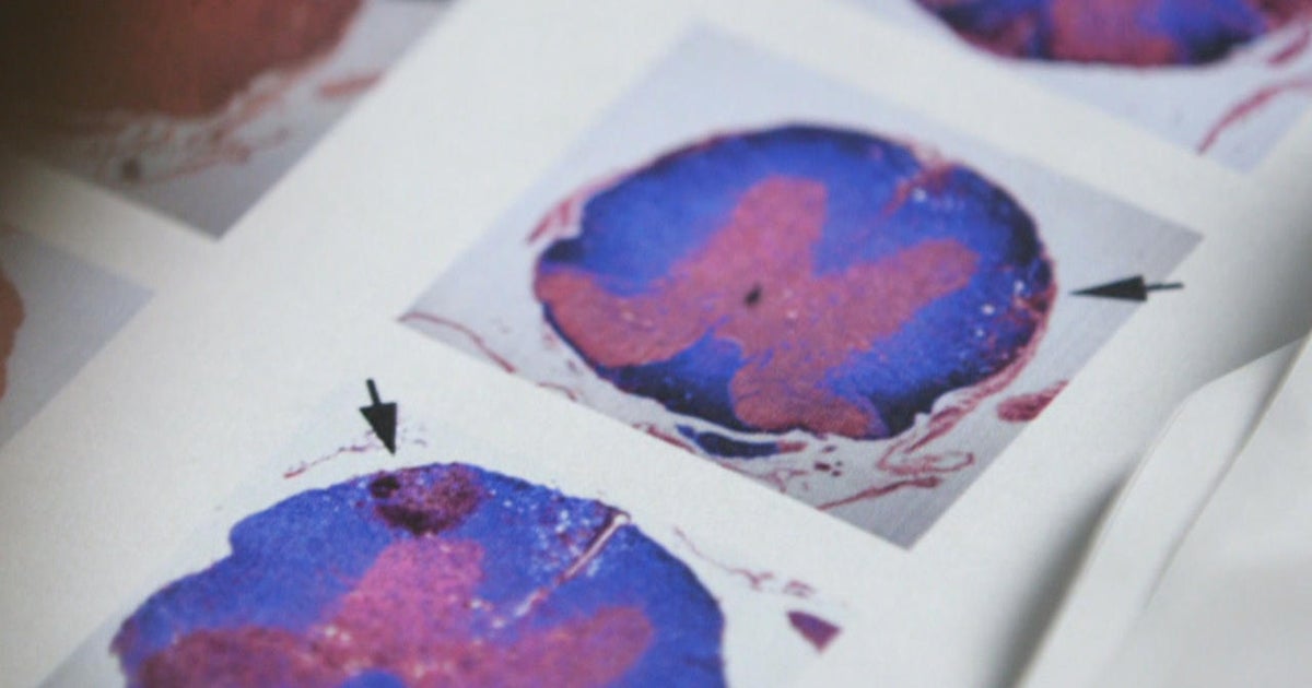 Scientists studying brains of altruistic kidney donors who give organs to strangers