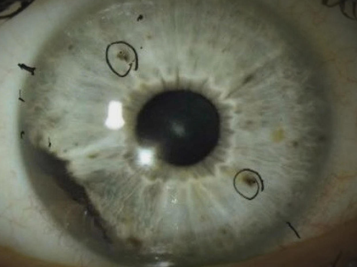 What Is Ocular Melanoma Medical Mystery Shines Light On Rare Eye