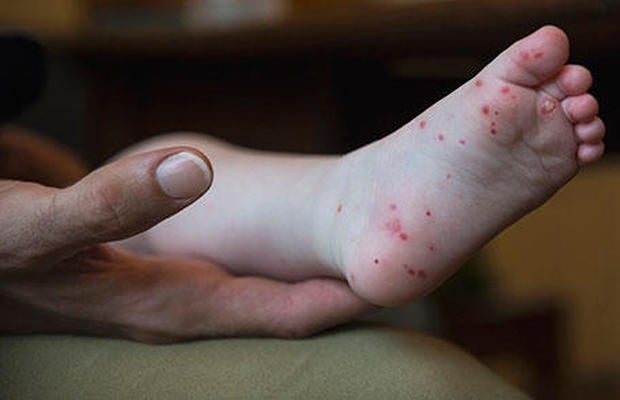handfootmouthdisease-456px.jpg