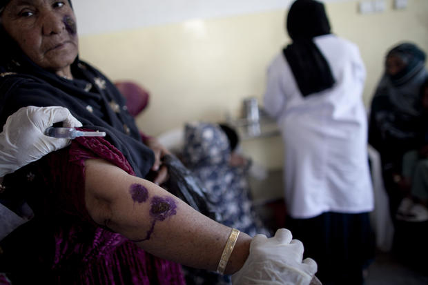 Sand-Fly Skin Disease Besets Afghanistan 