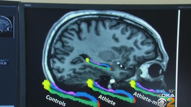 athlete-brain-scan 