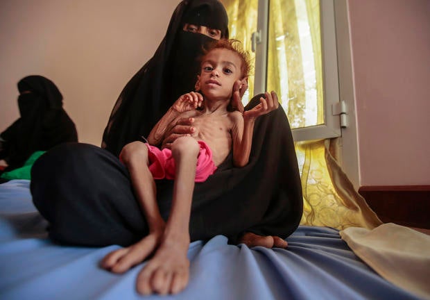 Yemen Displaced into Hunger Photo Essay
