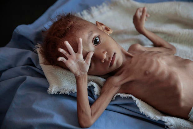 APTOPIX Yemen Displaced into Hunger Photo Essay